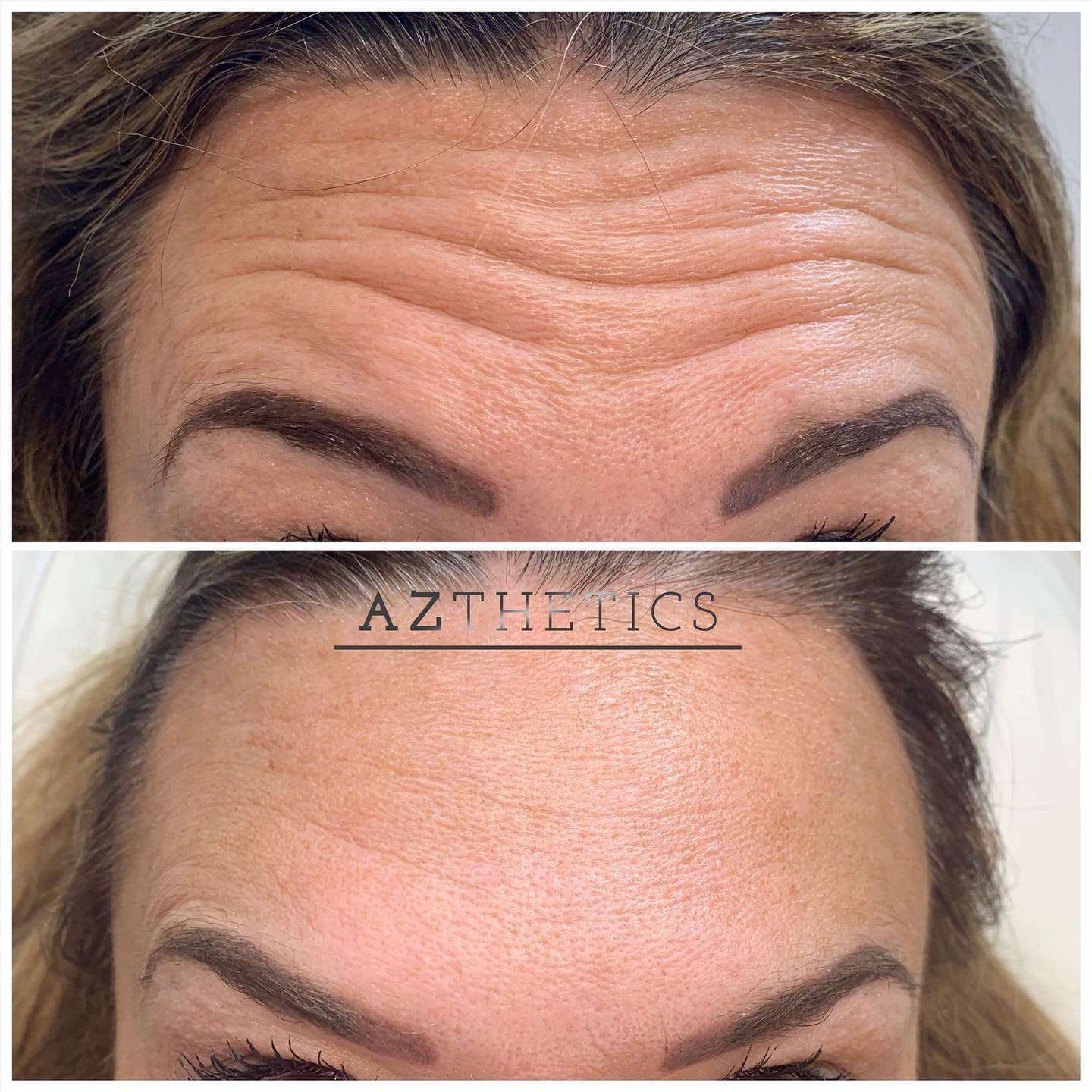 Botox Before and After
