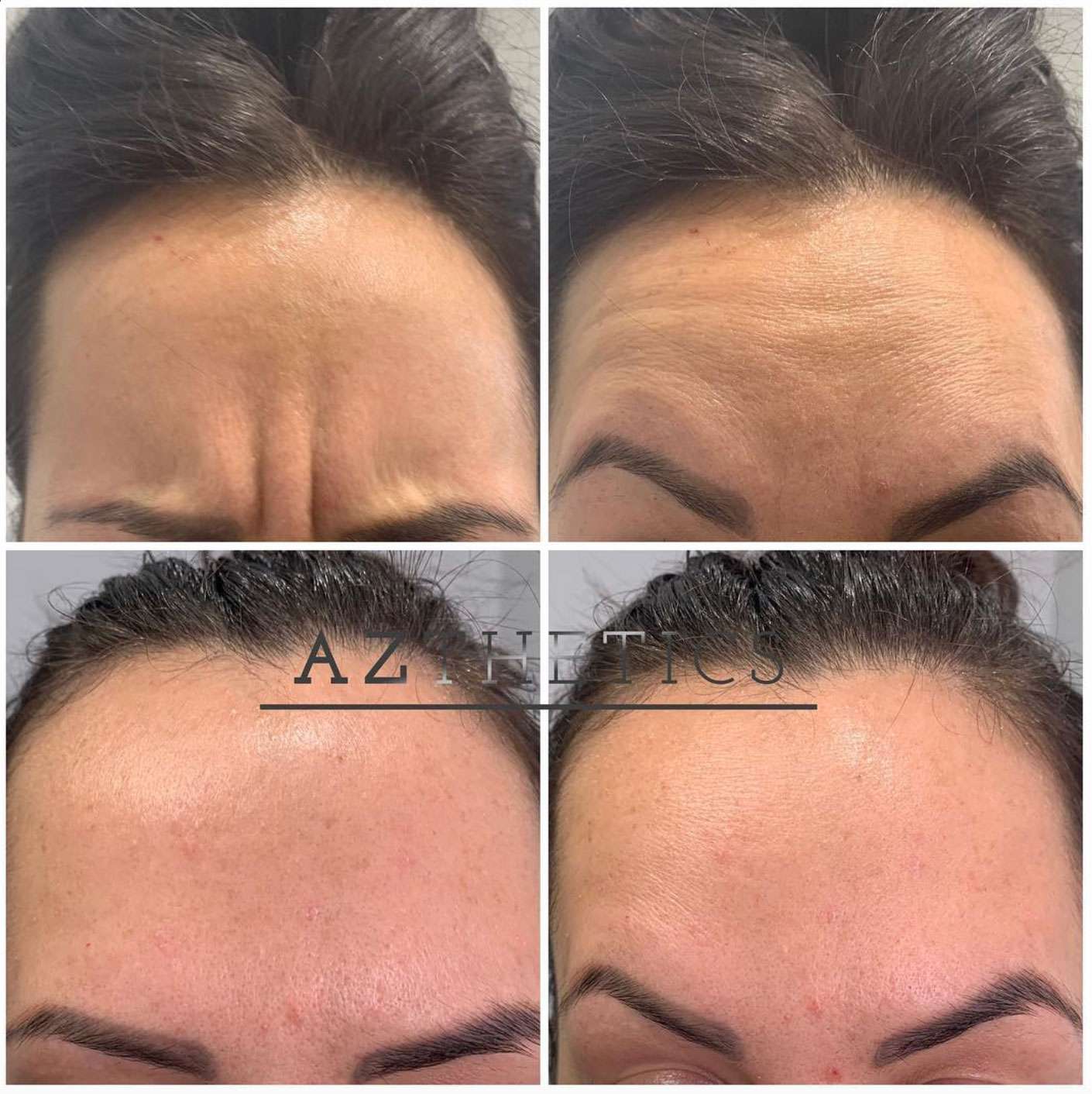 BOTOX before and after 
